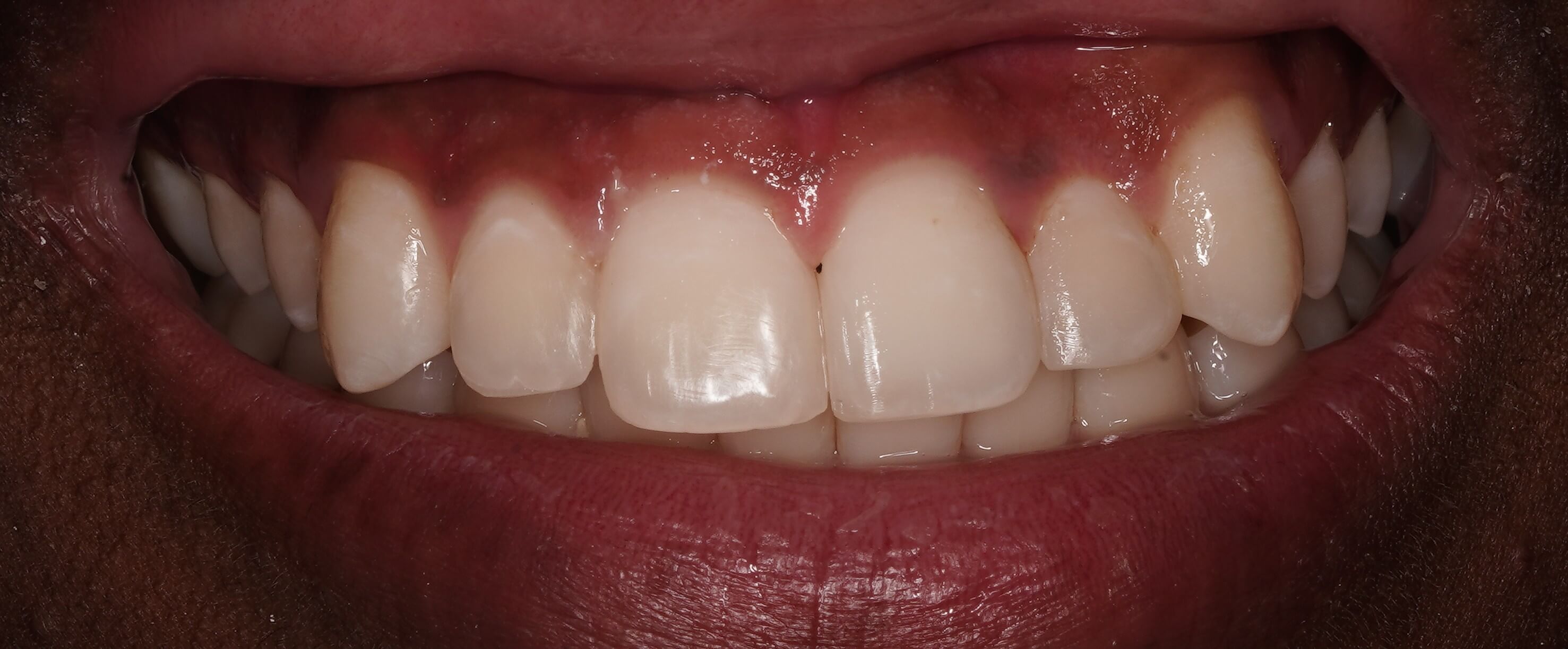 After treatment